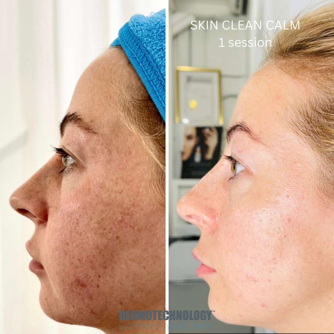 Avant / après Skin Clean Calm après 1 séance, vu de profil
