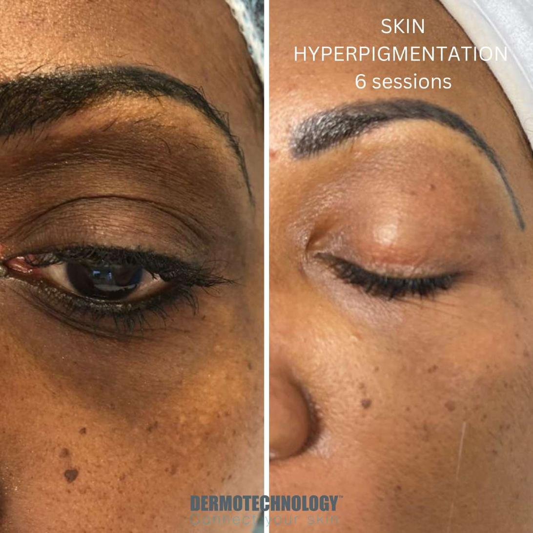 Avant / après Skin Hyperpigmentation après 6 séances, contour de l’œil