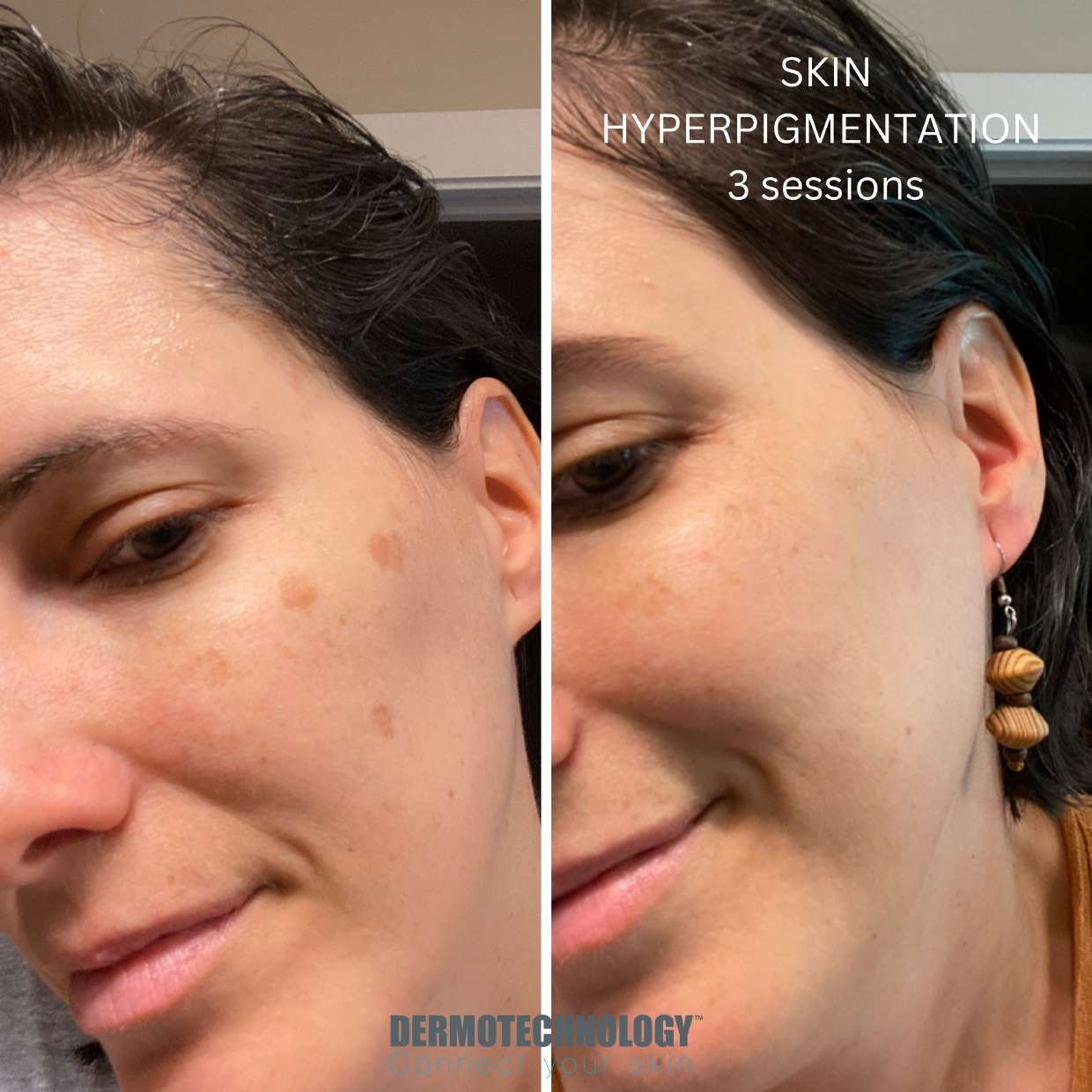 Avant / après Skin Hyperpigmentation après 3 séances, visage