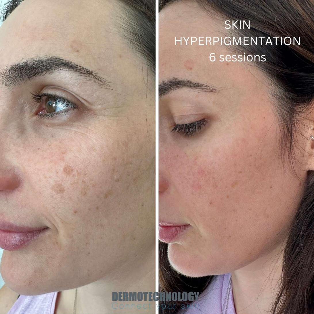 Avant / après Skin Hyperpigmentation après 6 séances, visage