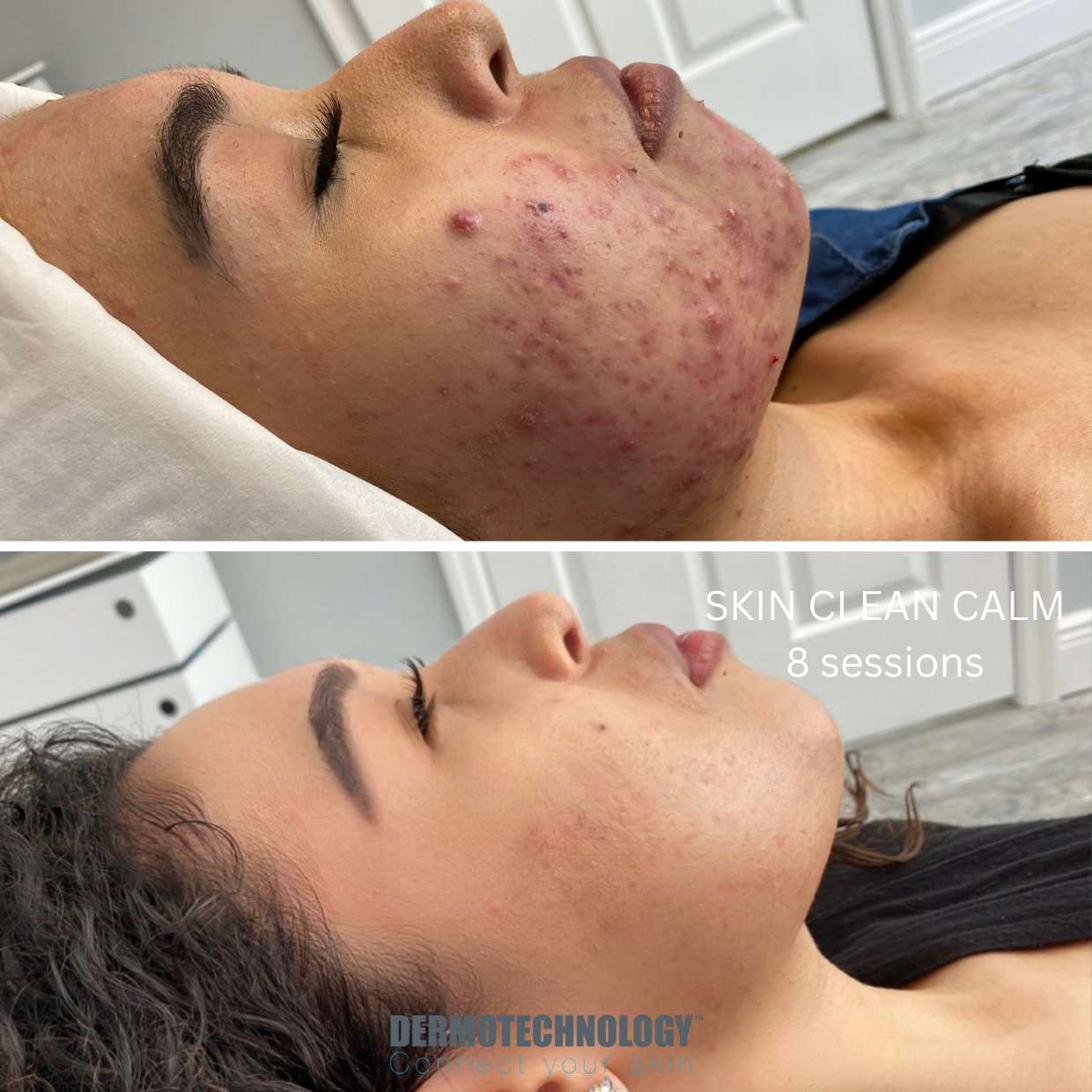 Avant / après Skin Clean Calm après 8 séances sur acné, profil