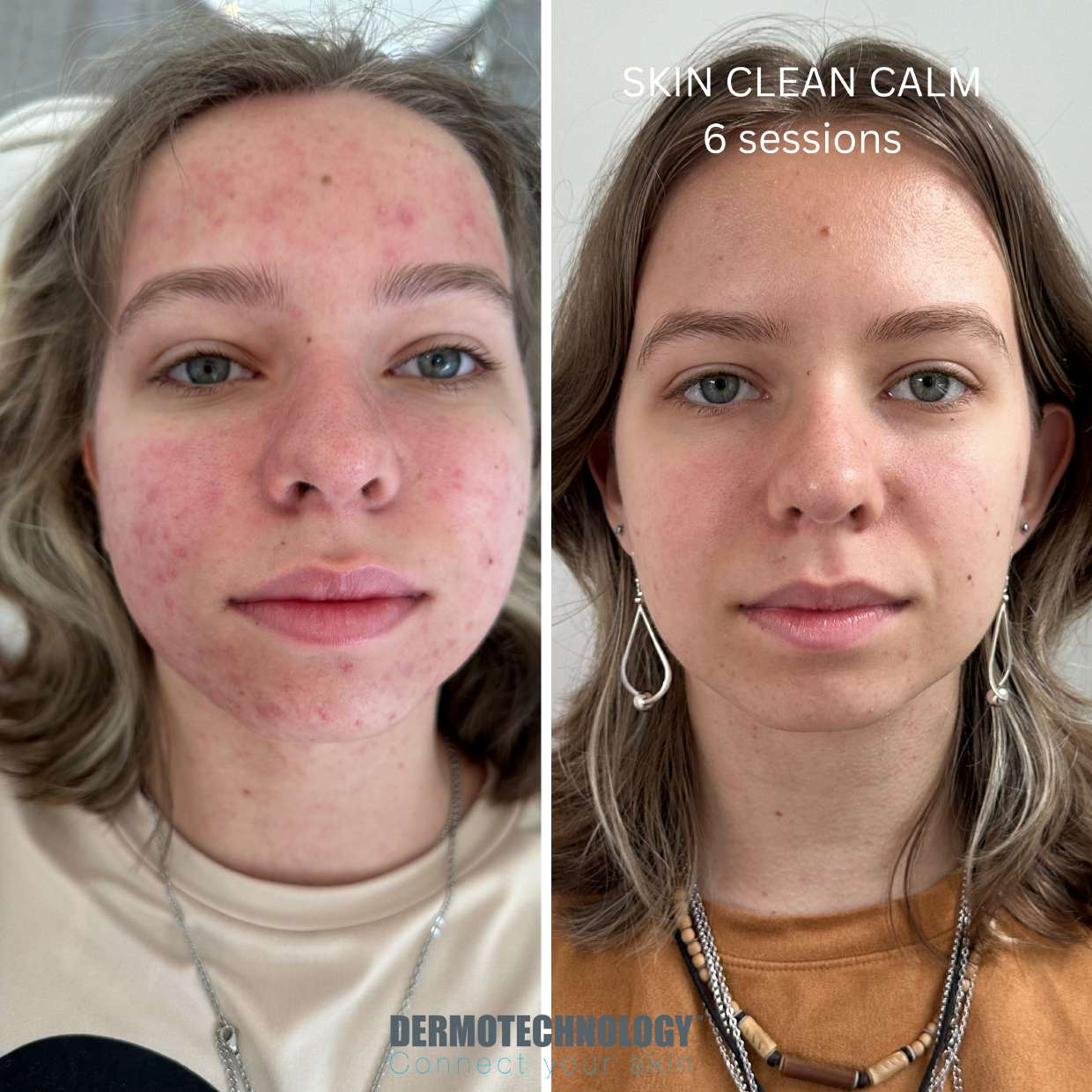 Avant / après Skin Clean Calm après 6 séances sur acné, visage