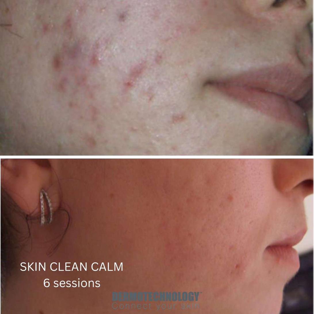 Avant / après Skin Clean Calm après 6 séances sur acné, joue