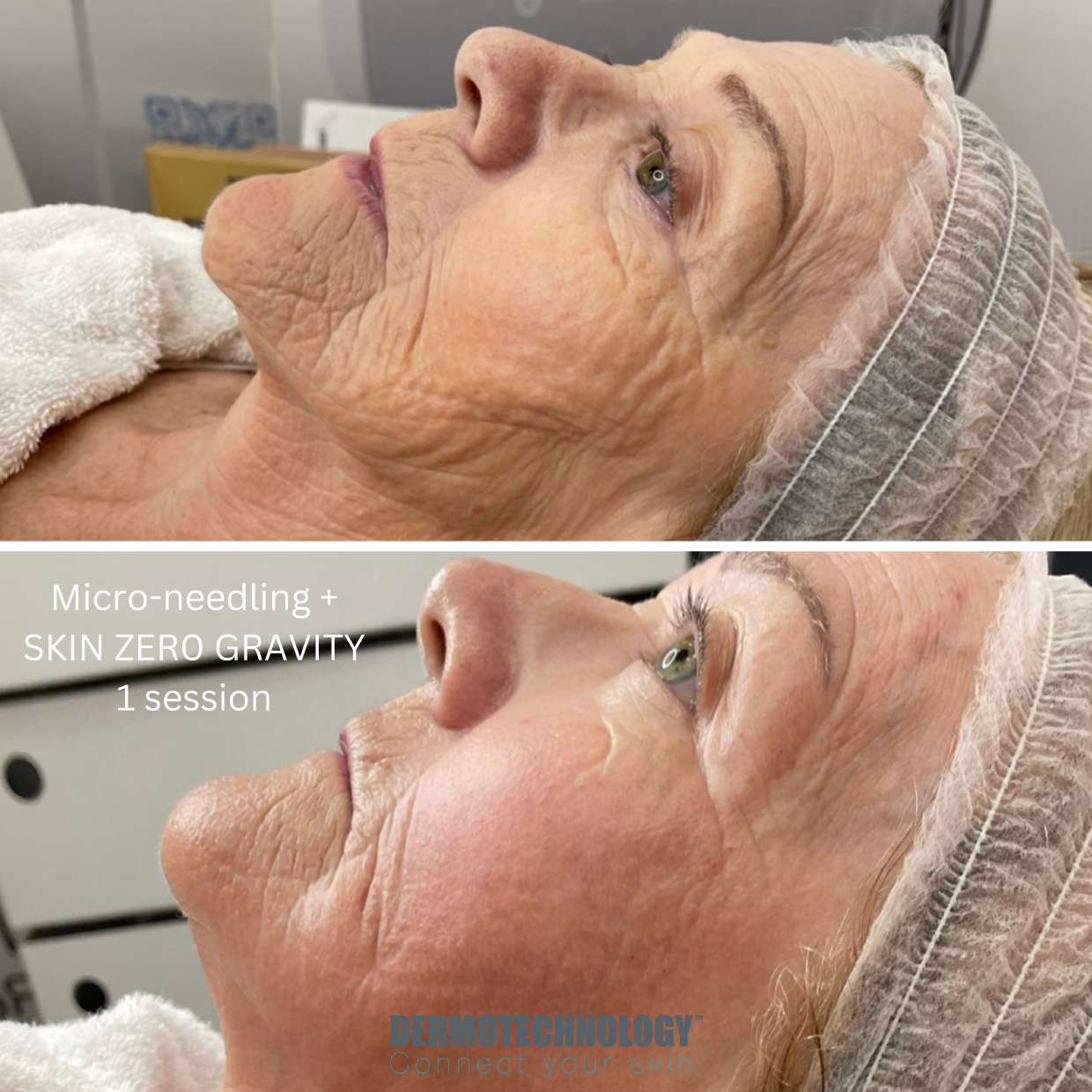 Avant / après micro-needling combiné à Skin Zero Gravity après 1 séance, profil