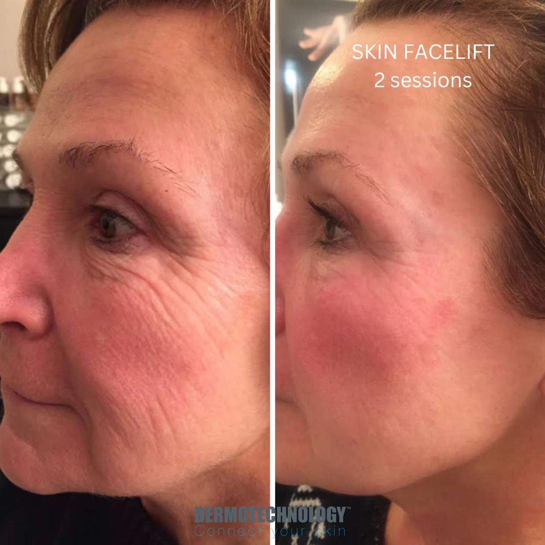 Avant / après Skin Facelift après 2 séances, contour de l’œil