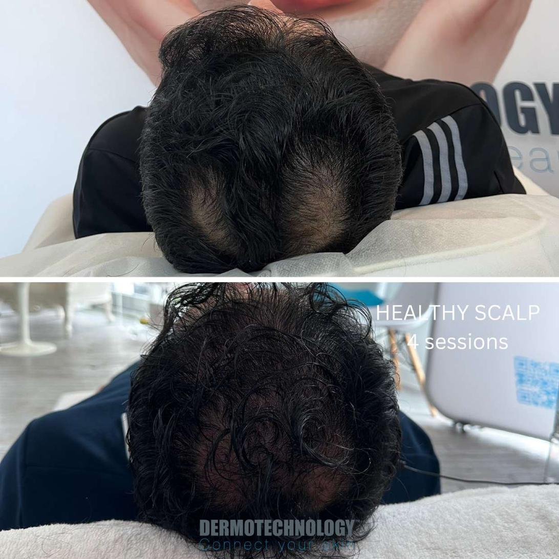 Avant / après Healthy Scalp après 4 séances, cuir chevelu
