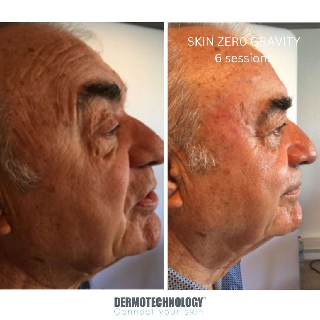 Avant / après Skin Zero Gravity après 6 séances, homme de profil