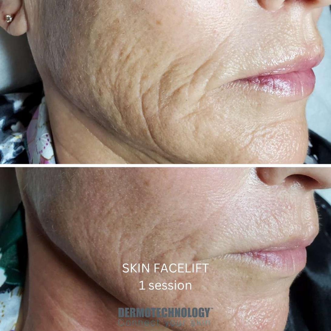 Avant / après Skin Facelift après 1 séance, contour de la bouche