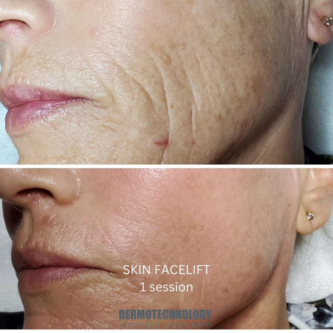 Avant / après Skin Facelift après 1 séance, joue