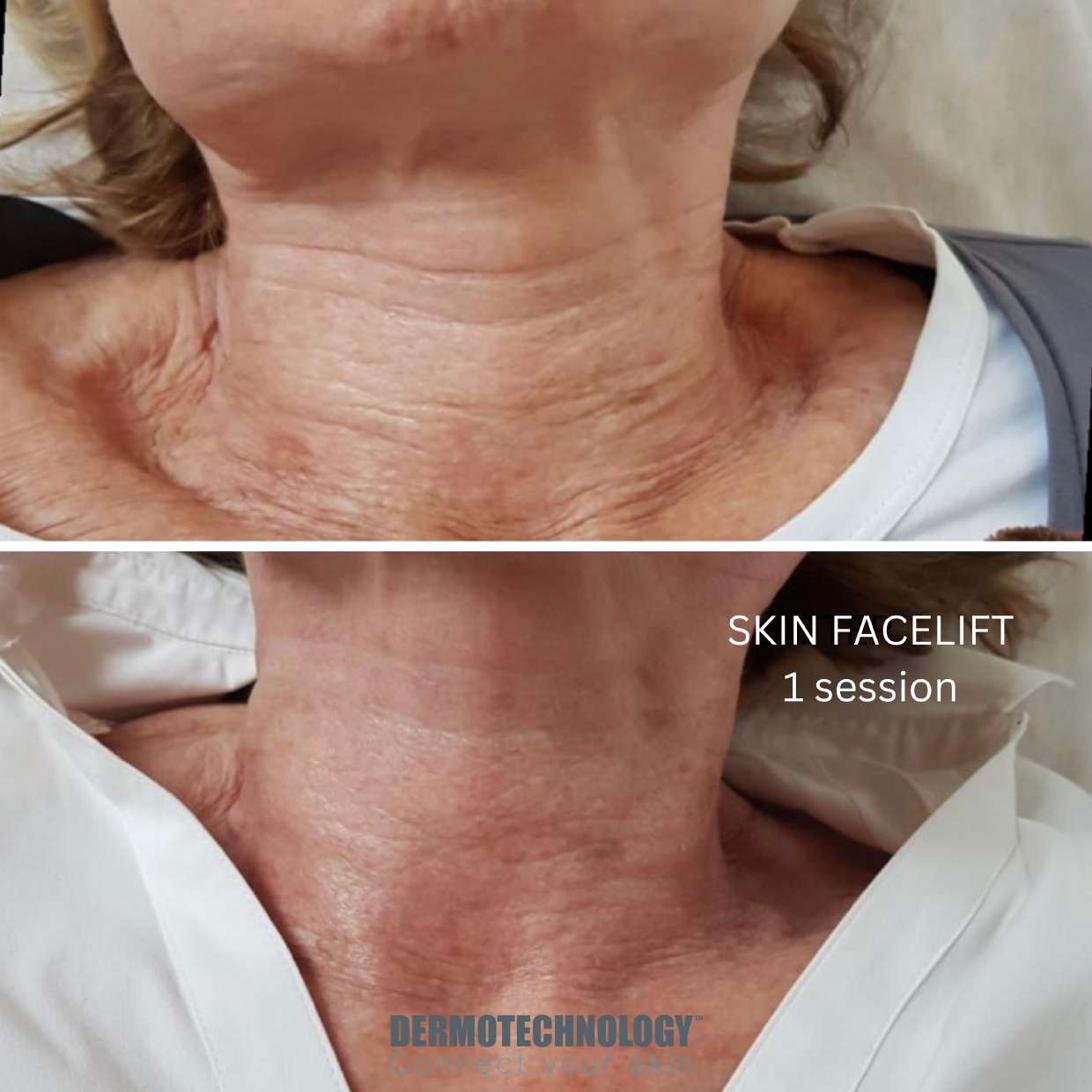 Avant / après Skin Facelift après 1 séance, cou