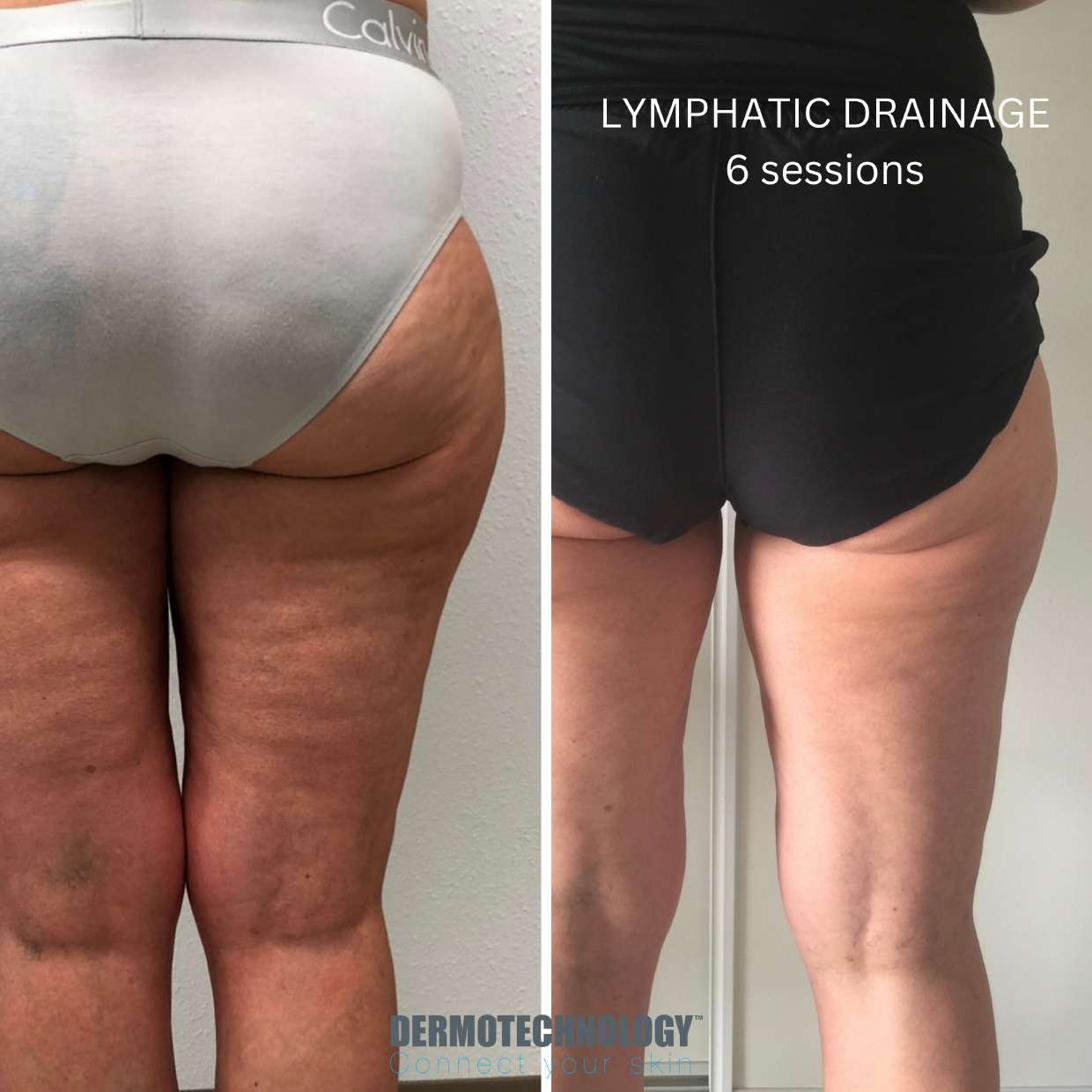 Avant / après drainage lymphatique après 6 séances, cuisses