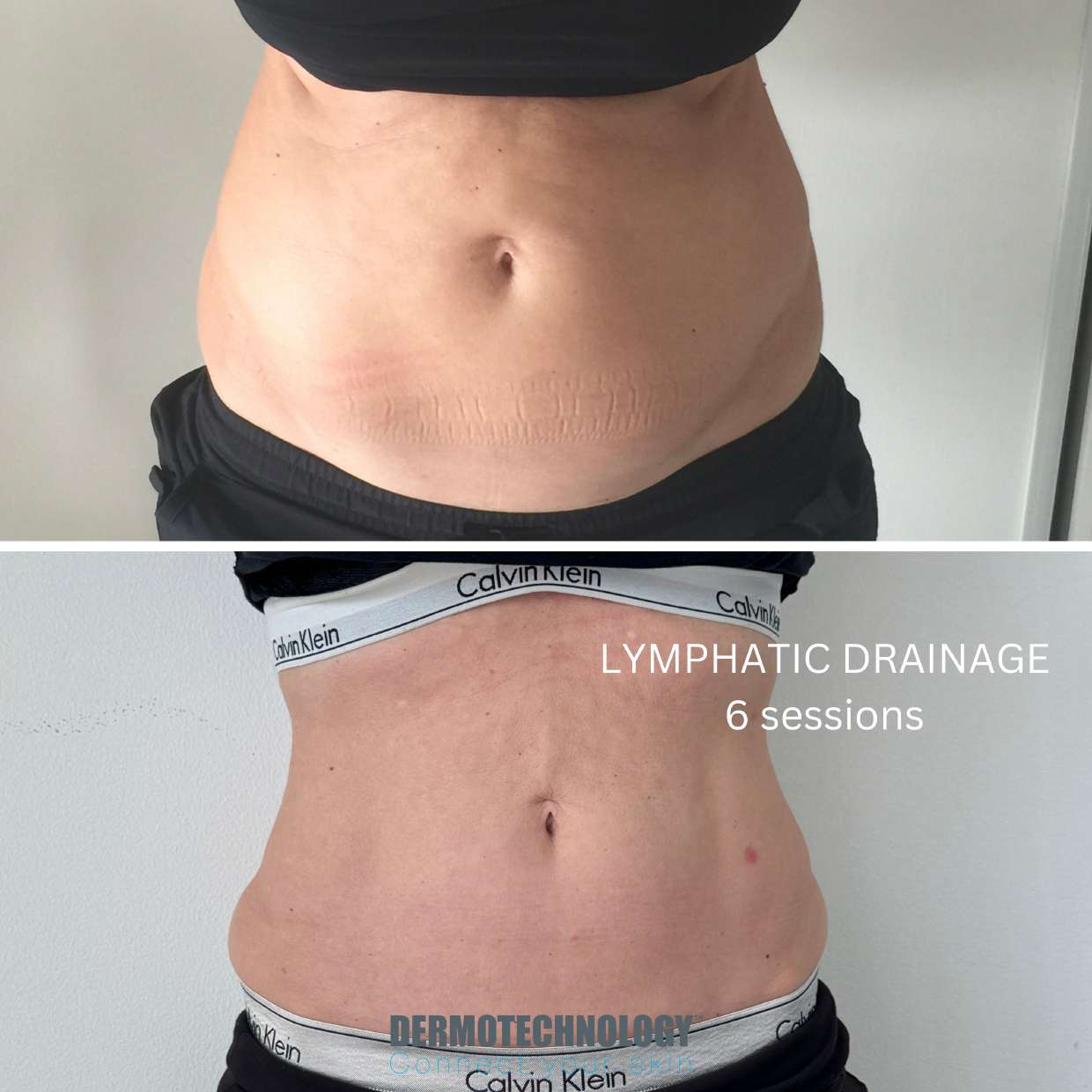 Avant / après drainage lymphatique après 6 séances, ventre