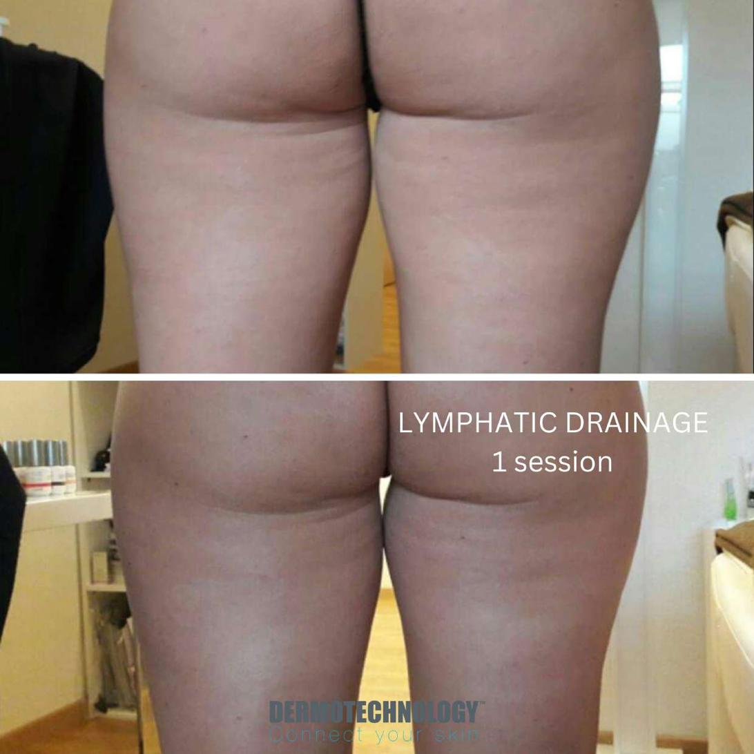 Avant / après drainage lymphatique après 1 séance, cuisses